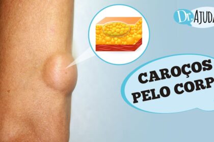 Caroços pelo corpo e lipoma: O que são? O que reparar?