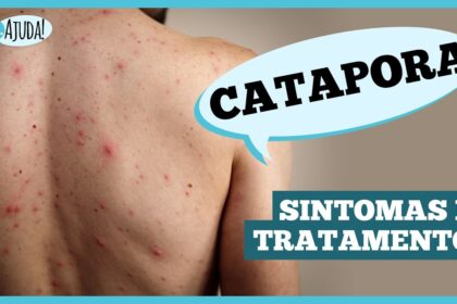 Catapora: sintomas, complicações e prevenção
