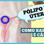 O que são pólipos uterino e quais os sintomas?