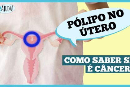 O que são pólipos uterino e quais os sintomas?