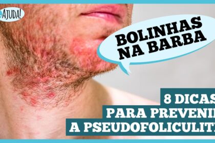Pseudofoliculite: saiba como prevenir