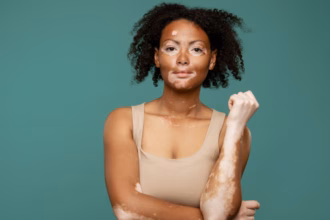 Entenda as causas e os tratamentos para o vitiligo