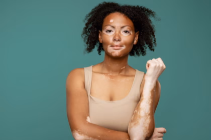 Entenda as causas e os tratamentos para o vitiligo