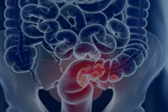 Rastreamento para câncer colorretal pode ser implementado no SUS