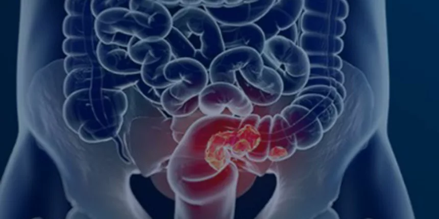 Rastreamento para câncer colorretal pode ser implementado no SUS Rastreamento para câncer colorretal pode ser implementado no SUS