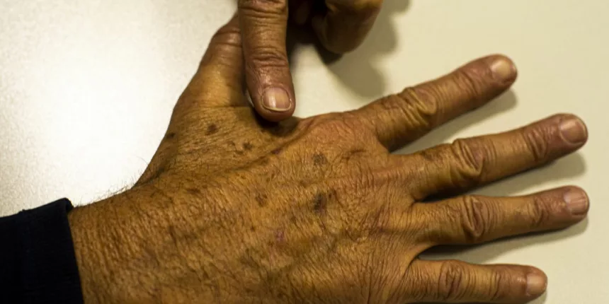 Desinformação sobre câncer de pele afeta diagnóstico, diz instituição Desinformação sobre câncer de pele afeta diagnóstico, diz instituição